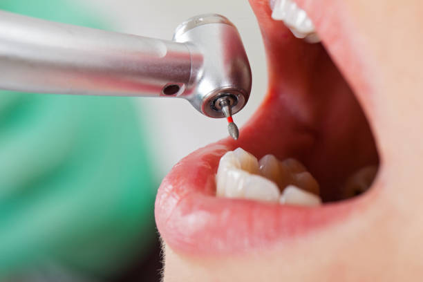 Best Emergency Tooth Extraction in Spring Hope, NC